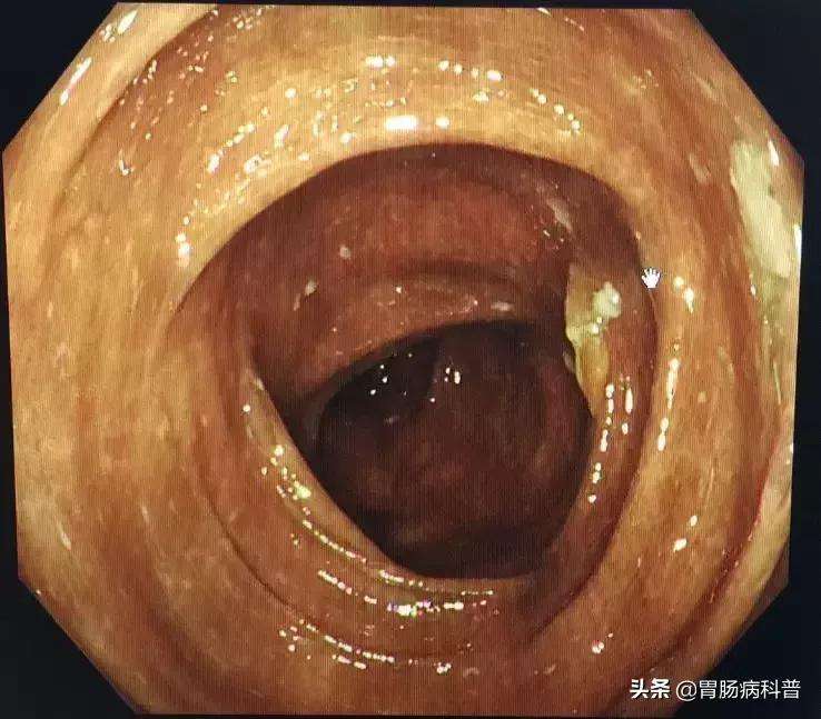 黑变病可以自愈的结肠黑变病