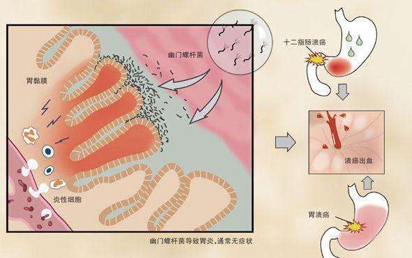 幽门螺杆菌感染不治疗可以自愈吗幽门螺杆菌感染治疗最佳方案
