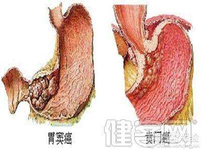 贲门失弛缓症,贲门