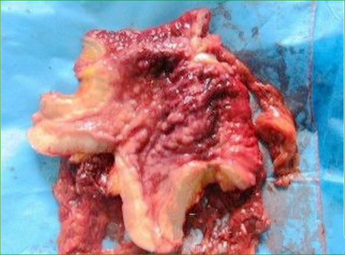 十二指肠球部肿瘤图片十二指肠息肉