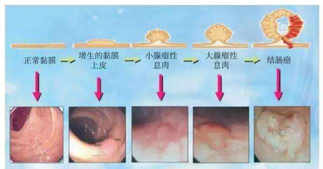 直肠肿瘤的症状,便血鲜红色无疼痛是什么原因