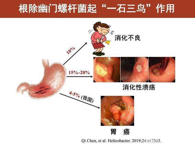 幽门杆菌的症状,幽门杆菌会自愈吗