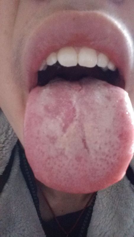 舌苔厚黄有口臭怎么治疗的简单介绍