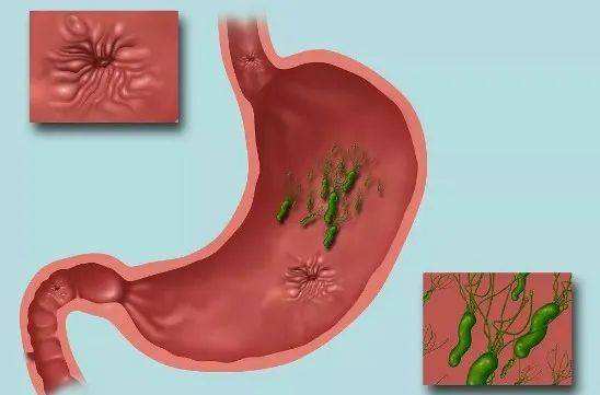 胃癌的早期症状有哪些胃炎和胃溃疡有什么区别
