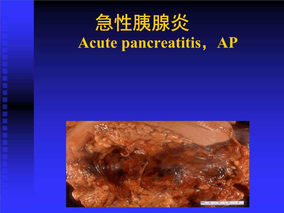 胰腺炎慢性胰腺炎的4大症状