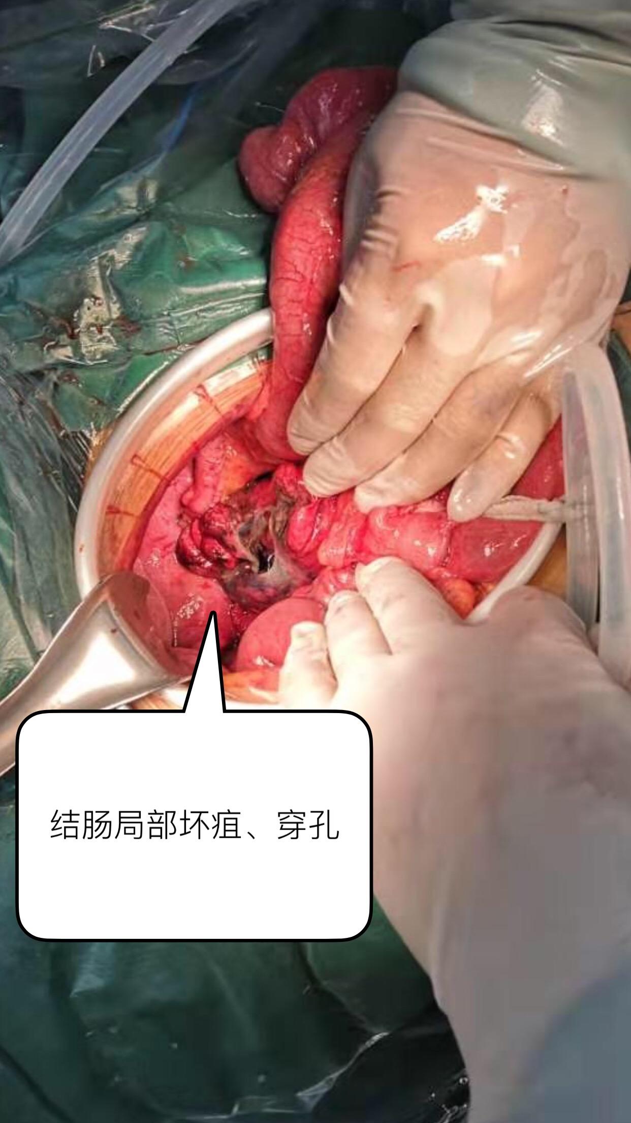 乙状结肠位置图,乙状结肠