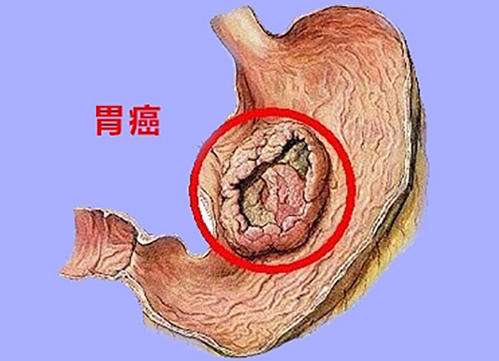 判断胃癌最简单方法胃癌早期有三处痛