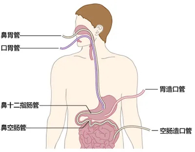 胃潴留胃潴留是怎么回事