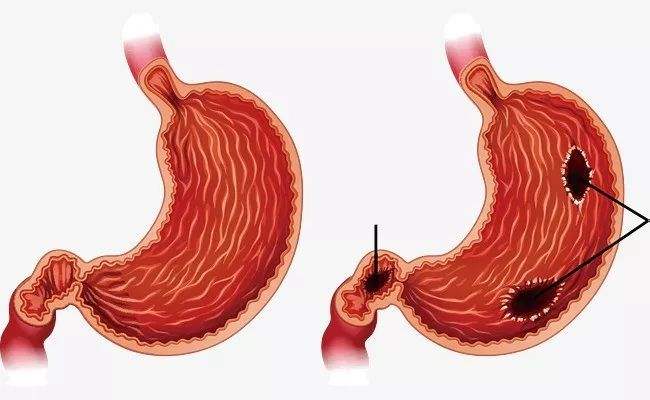 胃十二指肠溃疡的症状及治疗胃溃疡症状
