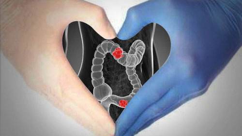 女性肠癌的10大征兆肠癌
