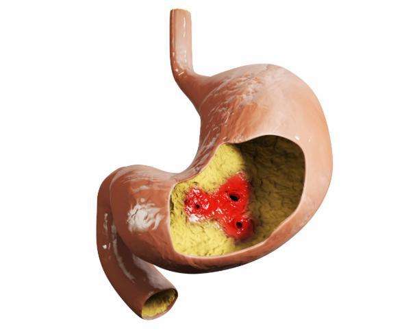 胃癌早期的12个征兆,胃癌的五大早期症状