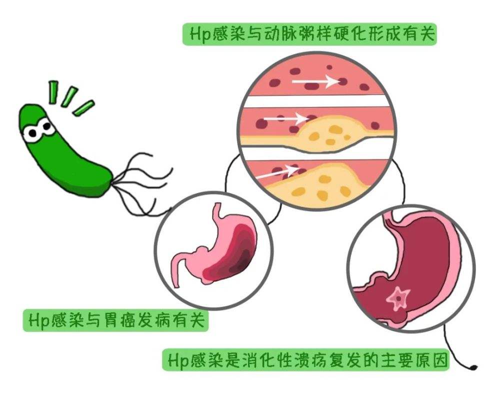 胃内幽门螺杆菌感染的症状,胃的幽门螺杆菌的症状