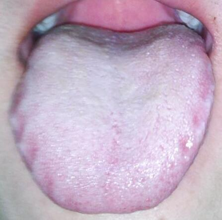 舌头有齿痕女性舌头两侧有齿痕