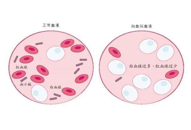 血红蛋白偏高是什么原因男性血红蛋白偏高说明了什么