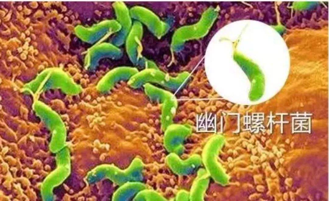 幽门螺旋杆菌怎么感染上的幽门螺杆菌是如何感染上的