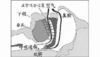 睡眠呼吸暂停综合症有什么症状原因睡眠呼吸暂停综合症有什么症状