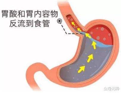 反流性食管炎怎么治返流性食管炎