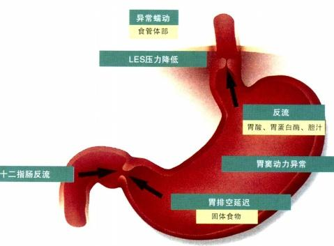 反流性食管炎怎么治返流性食管炎