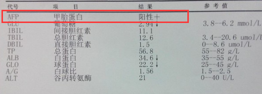 甲胎蛋白甲胎蛋白异质体