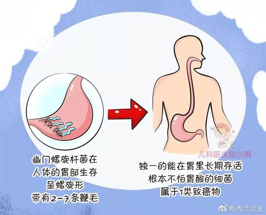 幽门螺旋杆菌症状,幽门螺旋杆菌有什么症状表现