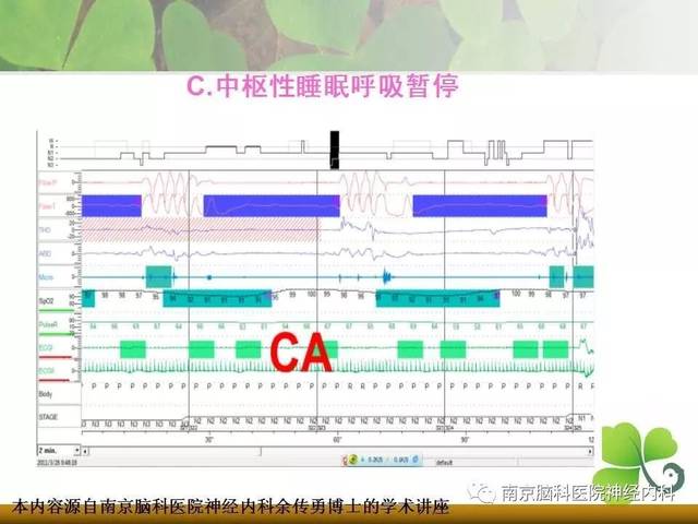 睡眠监测报告解读RI睡眠监测报告解读