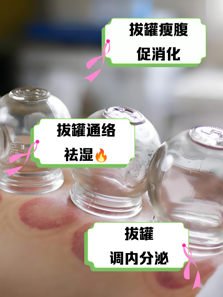 拔罐可以减肥吗都把那个部位拔罐可以减肥吗