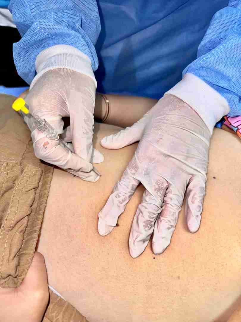 埋线减肥副作用和风险埋线减肥副作用