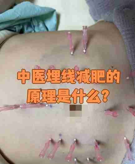 埋线减肥副作用和风险埋线减肥副作用